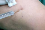 Escleroterapia