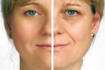 Rejuvenescimento Facial / Mãos