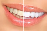 Branqueamento Dentário