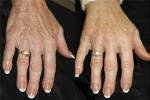 Tratamento de Rejuvenescimento das Mãos