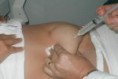 Tratamento de Mesoterapia