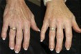 Tratamento de Rejuvenescimento das Mãos