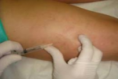Escleroterapia